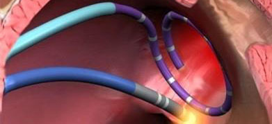 Nueva tecnología para tratar la fibrilación auricular, la arritmia cardiaca más frecuente