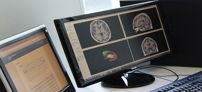 volBrain, referencia internacional para el estudio del cerebro y la investigación en neuroimagen