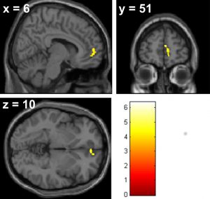Área de materia gris rACC correlacionada positivamente con la percepción del silencio mental.