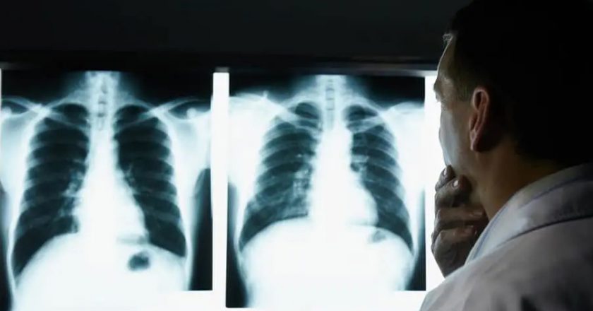 La COVID-19 aumenta el riesgo de tromboembolismo pulmonar en personas de mediana edad