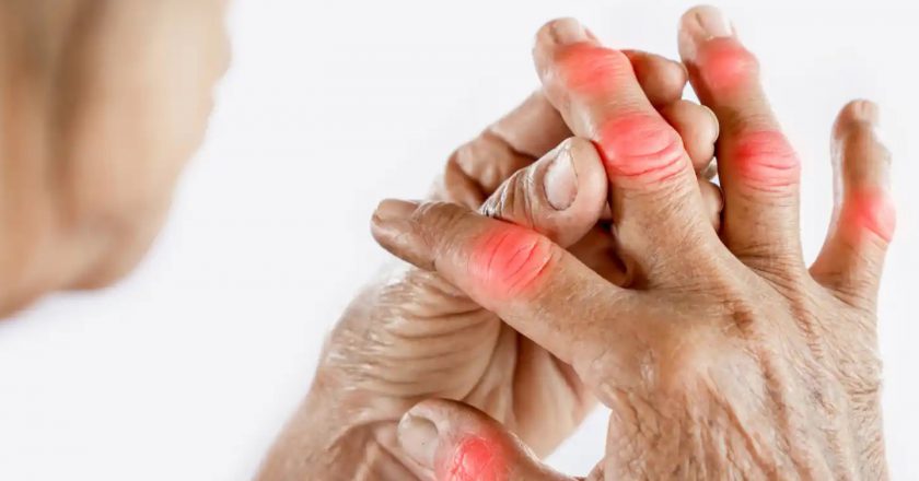 Avanzan en el conocimiento de los mecanismos moleculares de la artrosis para detectar potenciales dianas terapéuticas