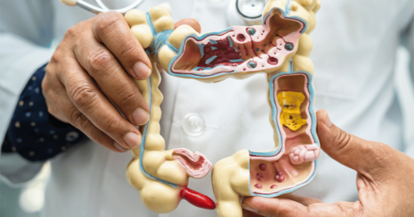 Un estudio muestra una nueva perspectiva sobre los mecanismos de progresión en la enfermedad de Crohn